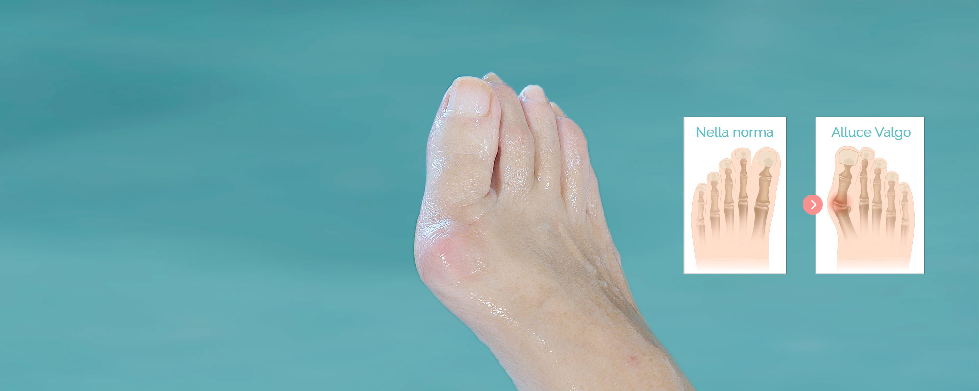 <b>Hallux valgus</b>